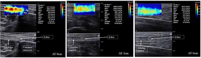Elasticity of the Achilles Tendon in Individuals With and Without Plantar Fasciitis: A Shear Wave Elastography Study